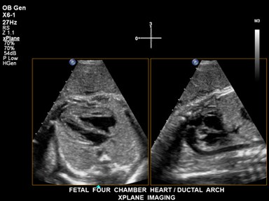Les informations supplémentaires fournies par l’imagerie xPlan temps réel présentent deux vues du cœur fœtal à quatre cavités et de la crosse du canal artériel.