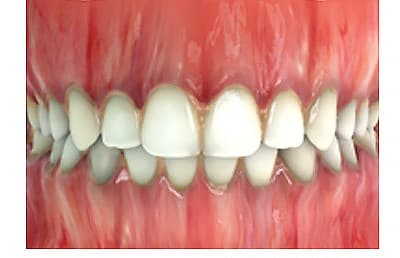 moderate-chronic-gingivitis