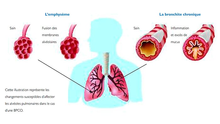 la bronchite chronique