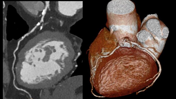 Download image (.jpg) Precise Suite Incisive cardiac