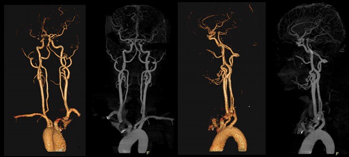 Download image (.jpg) Precise Suite Incisive carotid (Ouvre dans une nouvelle fenêtre)