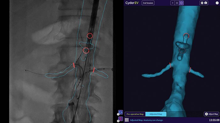Philips intègre les nouvelles technologies d'IA et de 3D dans ses C-arm (bras) mobiles (Zenition) pour améliorer le flux de travail et les traitements