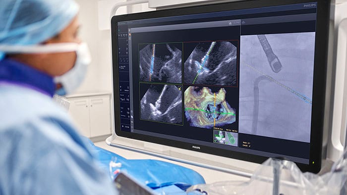 FDA clears Philips AI solution that provides real-time guidance during complex minimally invasive heart valve repair